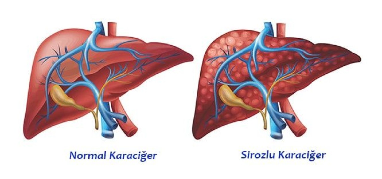 Siroz Tehlikeli Bir Hastalık Mıdır? 4