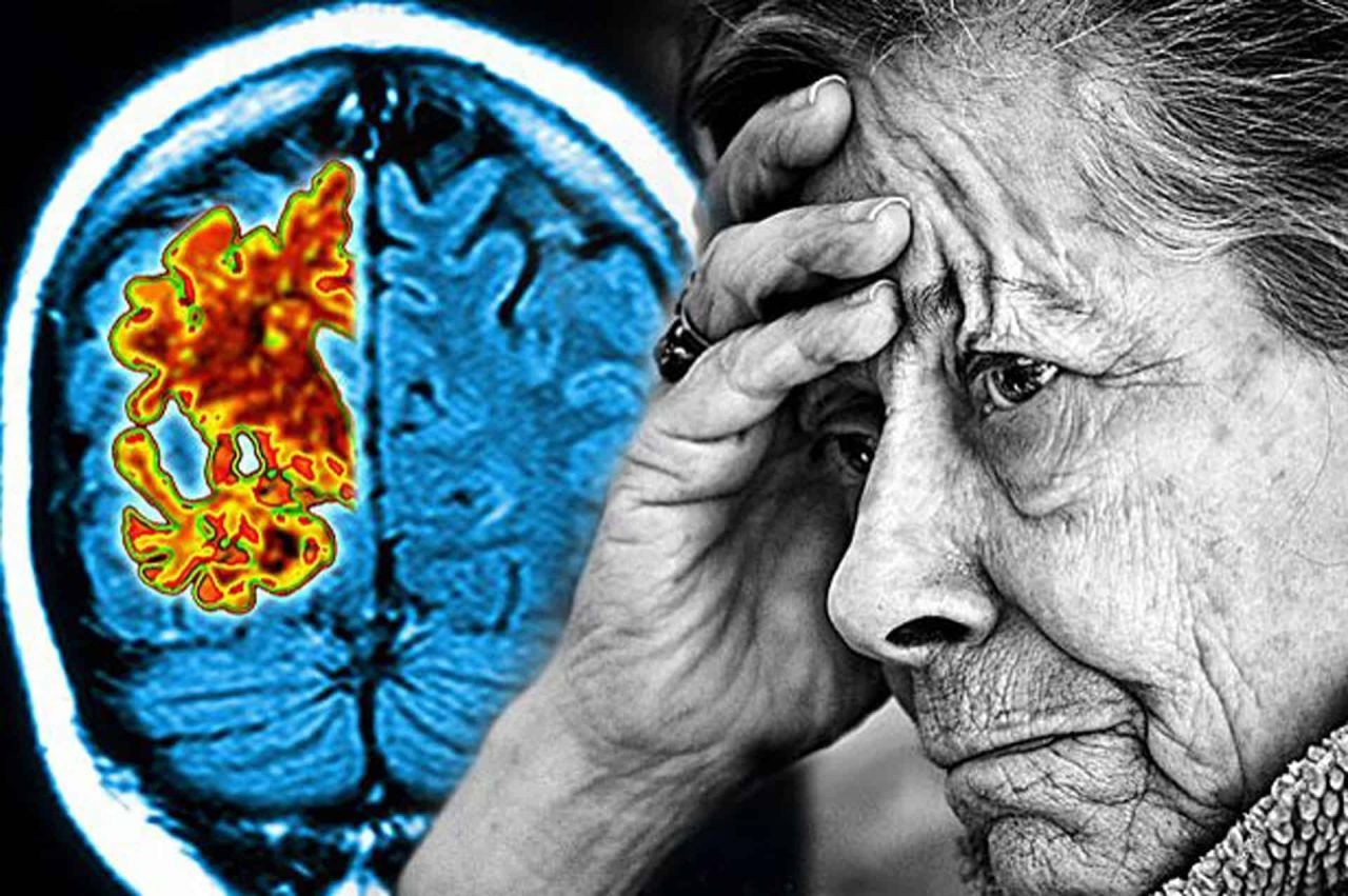 30’lu yaşlarda beyin yaşlanması “Alzheimer” hastalığını başlatıyor! Kalbi zayıf olanların bunama riski artıyor! 3