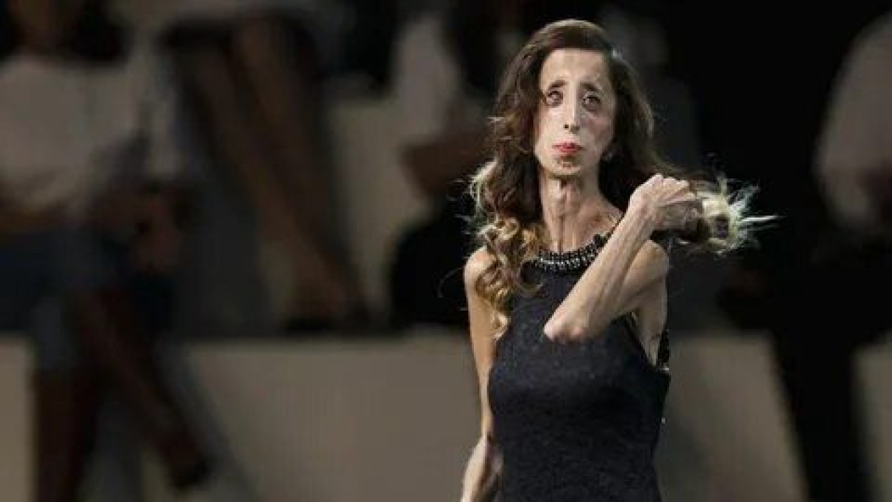 Lizzie velasquez: Dünyanın en çirkin kadını değil,  en cesur kadını... 2