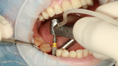 Diş implantları tehlikeli mi? En büyük tehlikesi nedir?